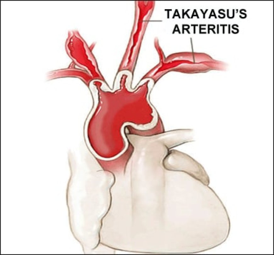 Arteritis, Takayasu