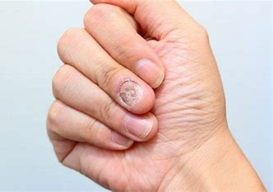 Nail Fungus