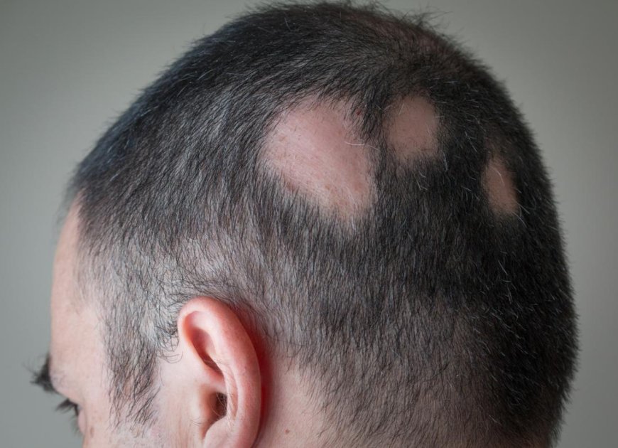 Alopecia Areta