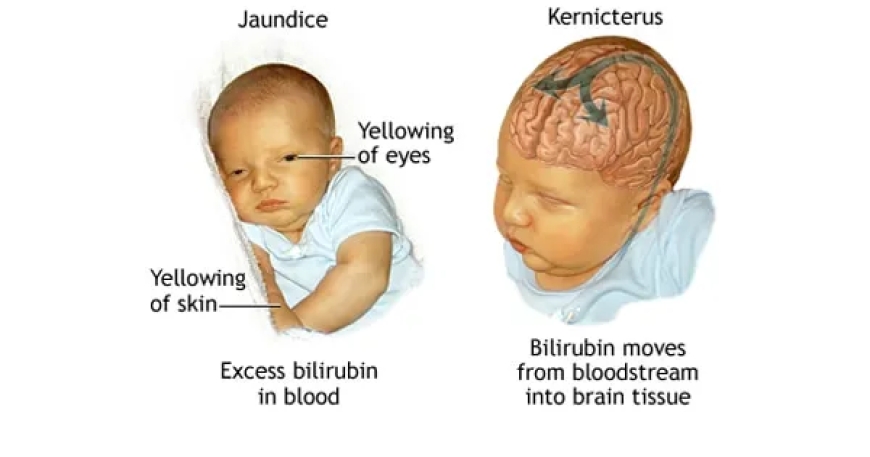 Kernicterus