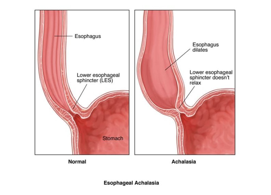 Achalasia