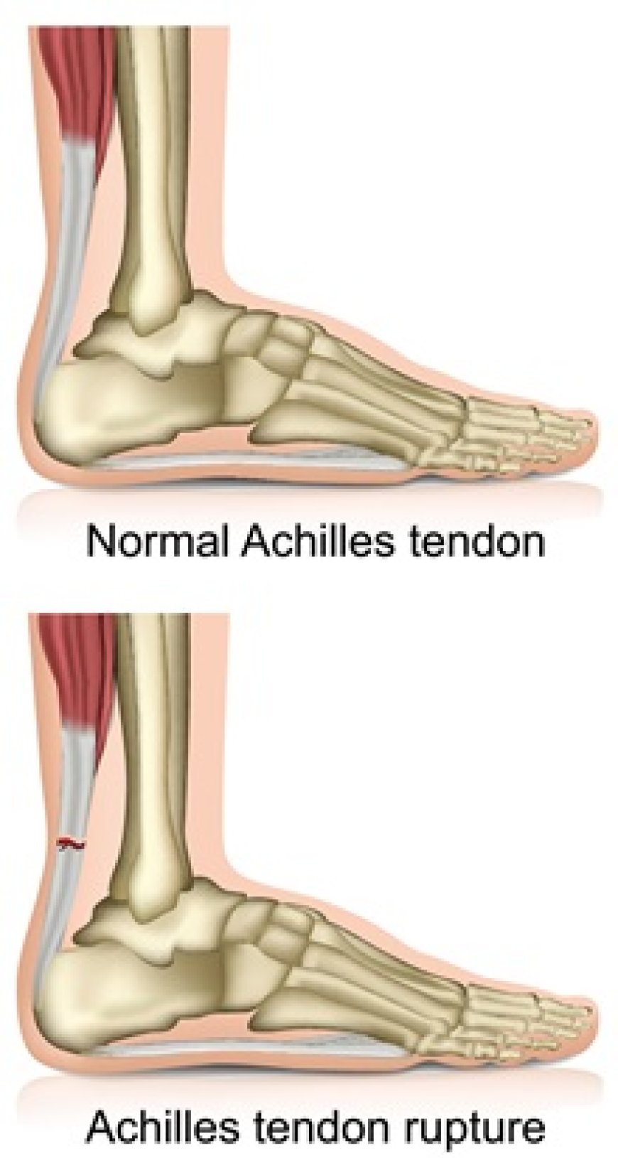 Achilles Tendon injury