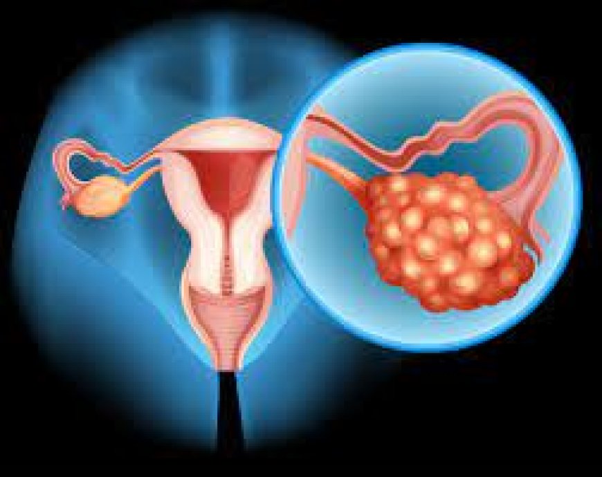 Ovarian cancer