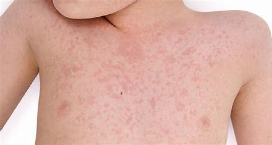 Rubella (German Measles)