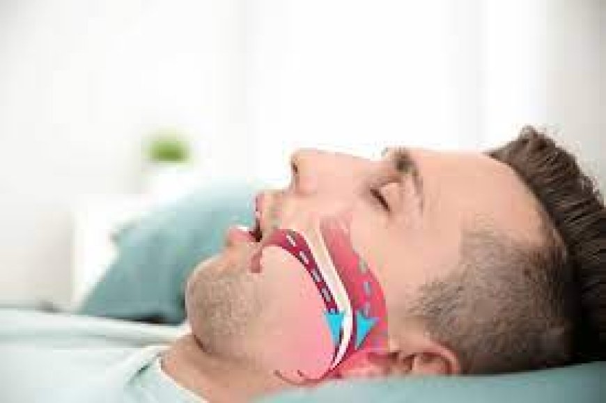 OBSTRUCTIVE SLEEP APNEA