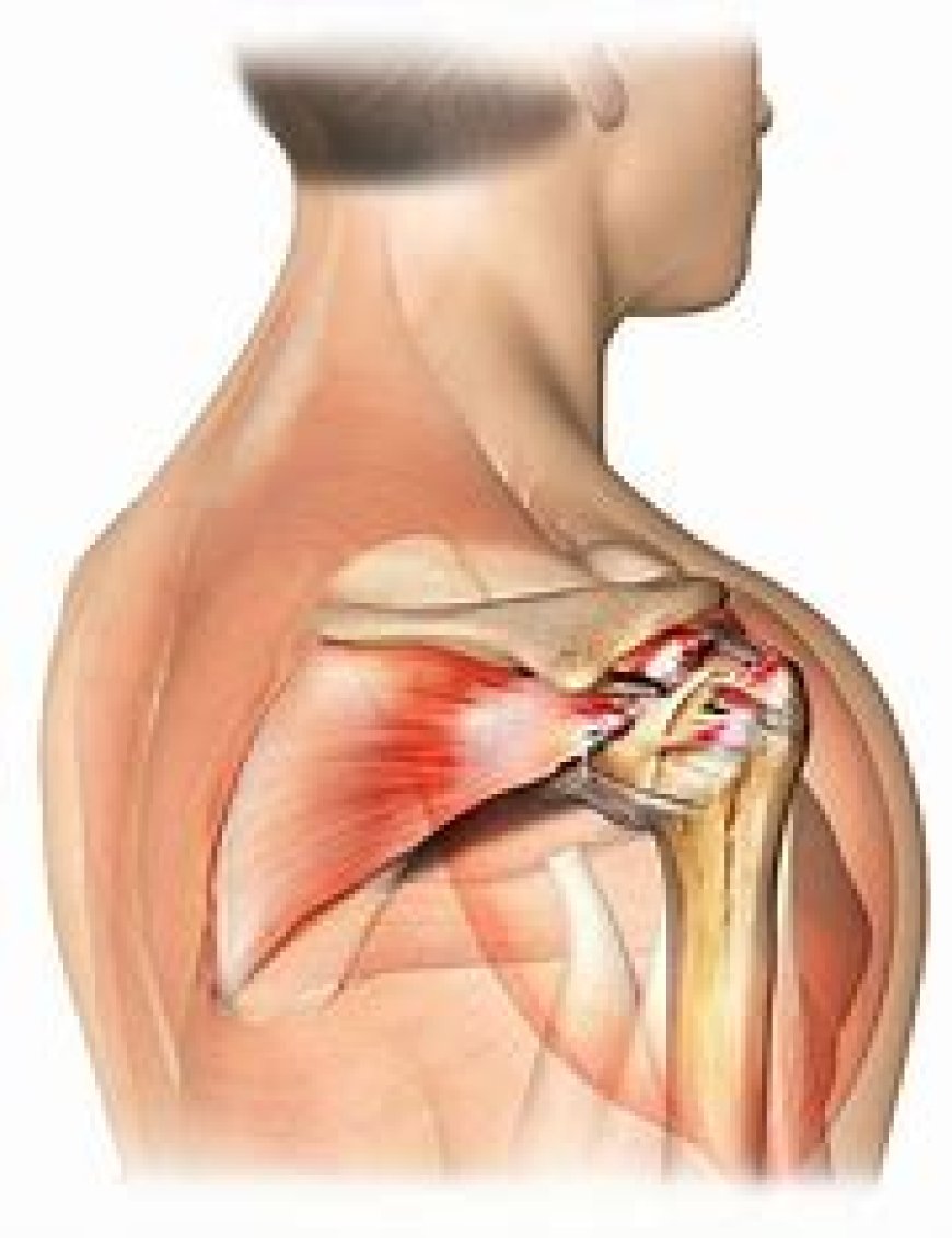 Rotator Cuff injuries