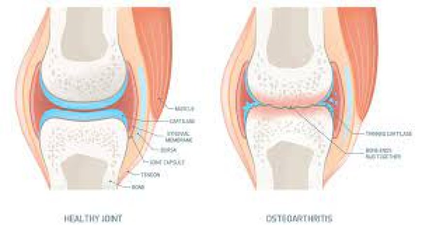 Osteoarthritis