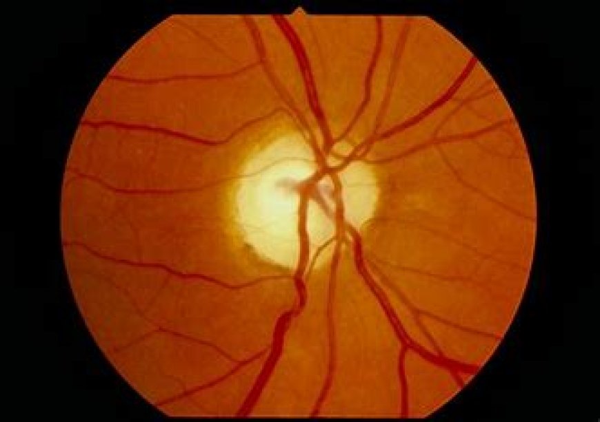 Retinal Diseases