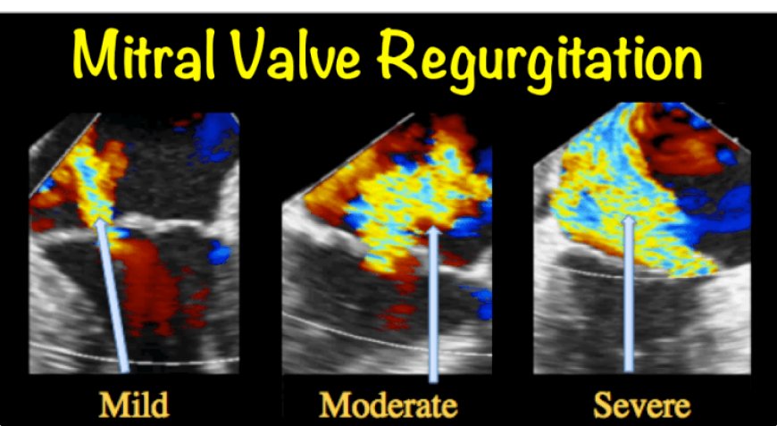 Mitral Valve Regurgitation