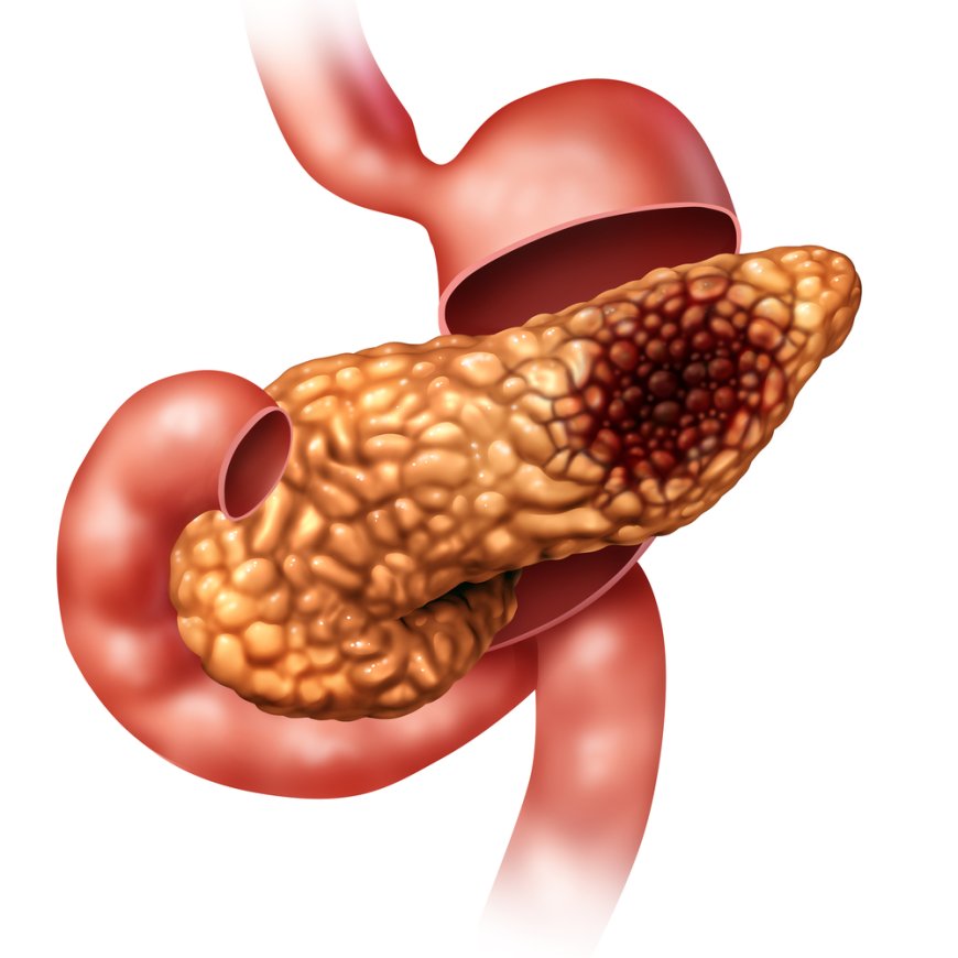 pancreatic cancer