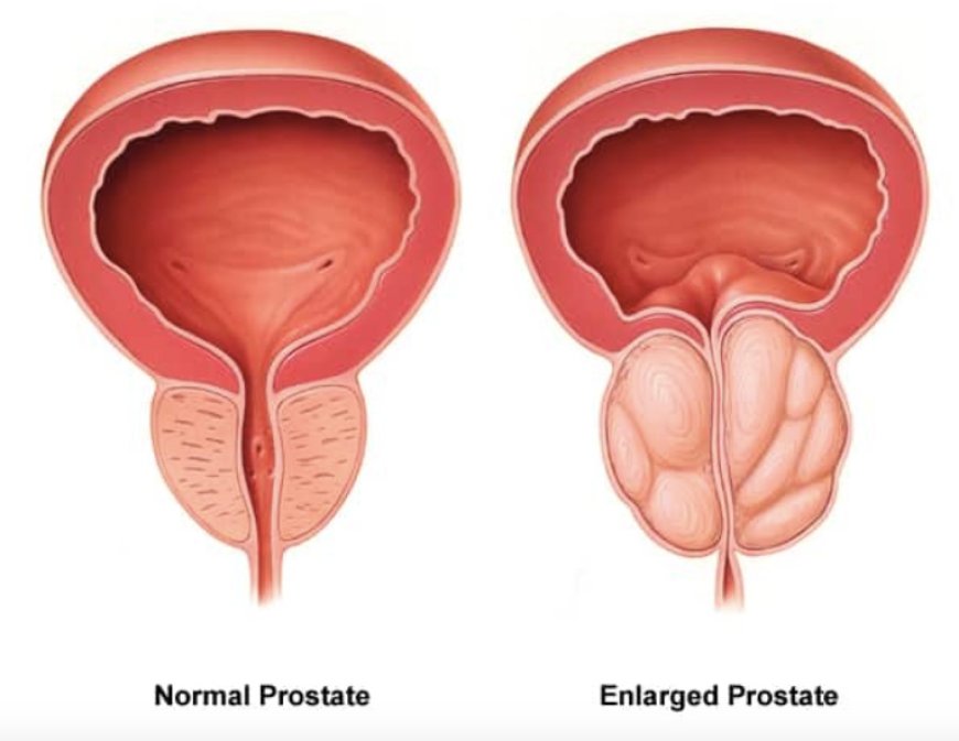 Prostate Enlargement BPH