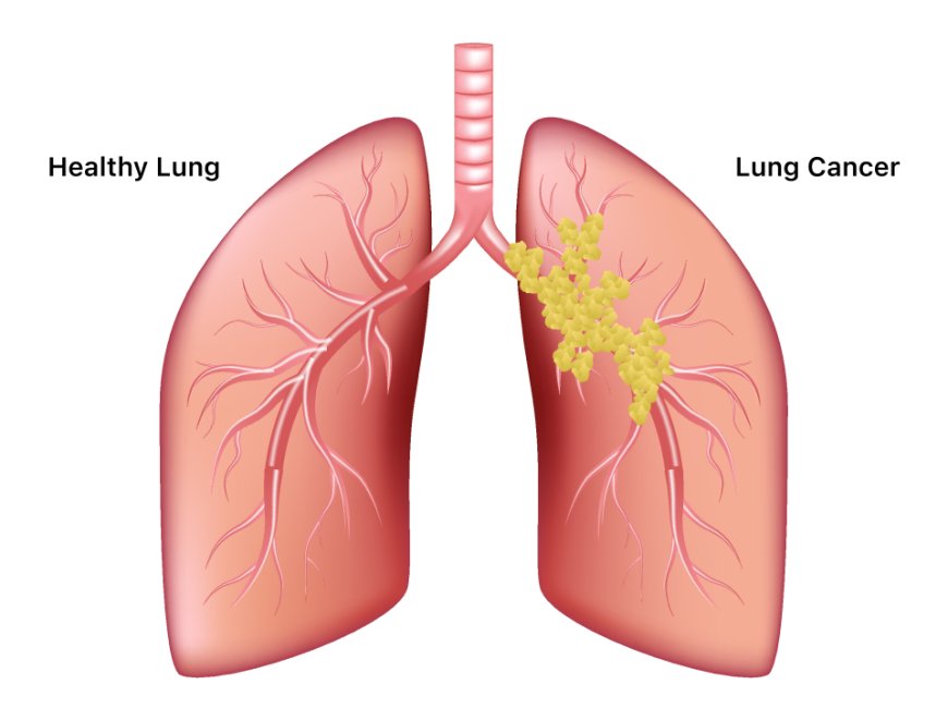 Non-small-cell Lung Cancer