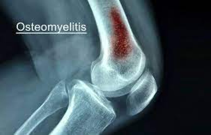 Osteomyelitis