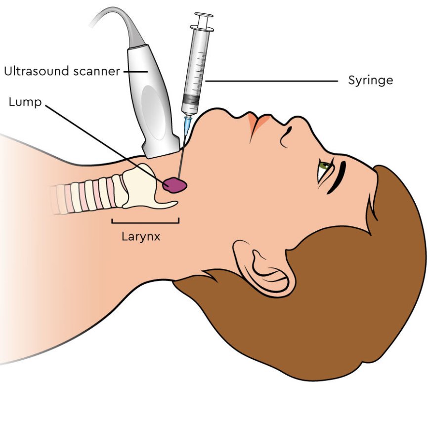 Needle Aspiration