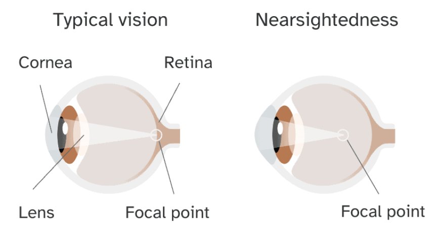 Nearsightedness