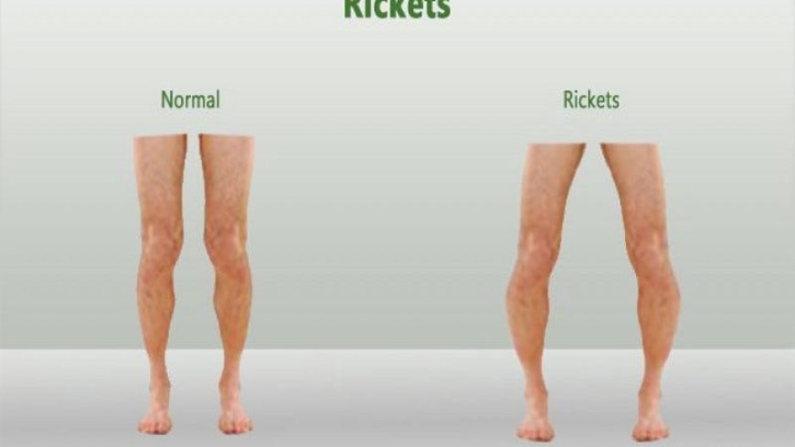 Nutritional Rickets( Vitamin D defficiency)