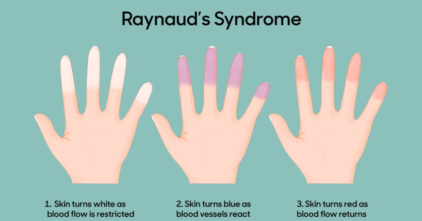 Raynaud's Disease