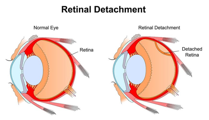 Retinal Detachment