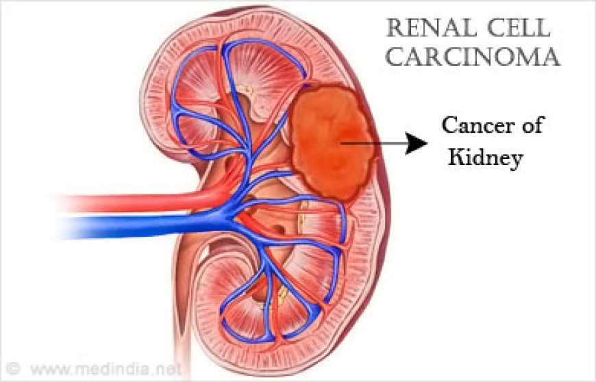 Renal Cell carcinoma ( RCC)