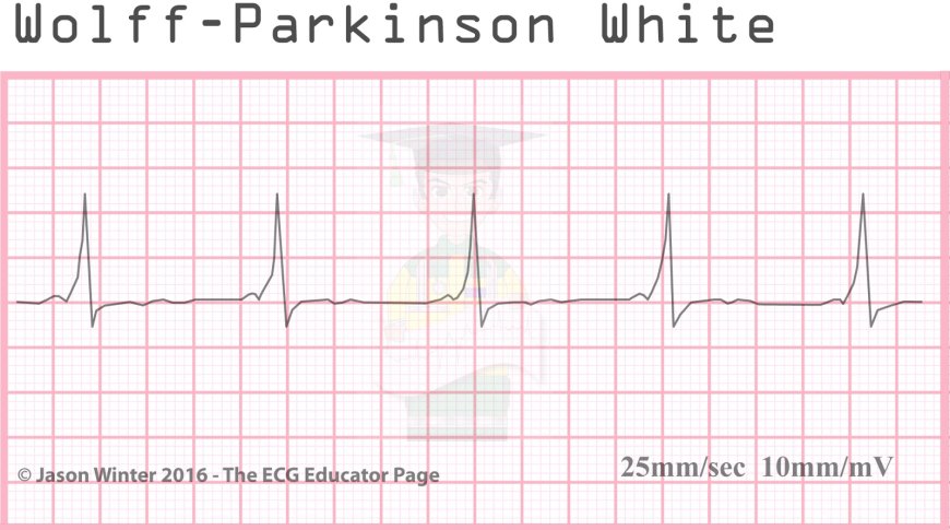 WPW syndrome