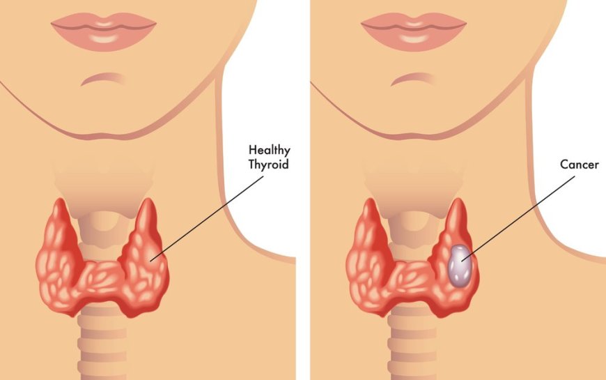 Thyroid Cancer