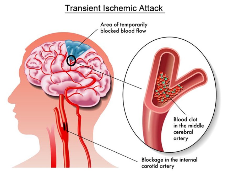 Transient Ischemic Attack (TIA)