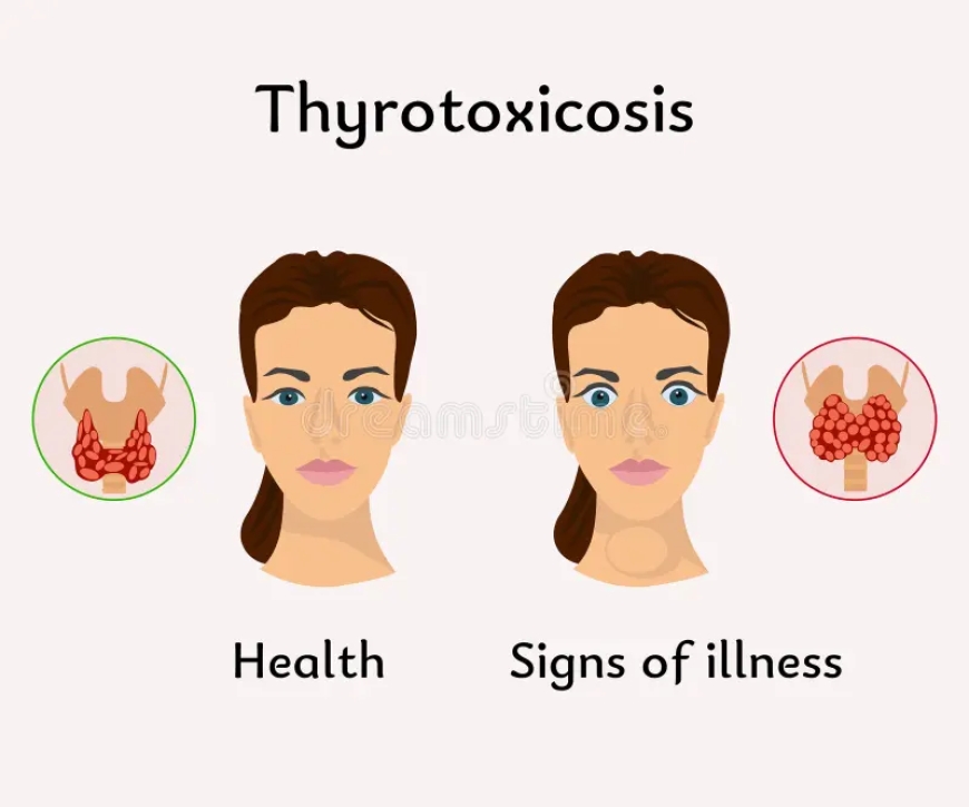 Thyrotoxicosis