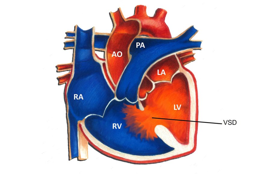 Ventricular septal defect (VSD)