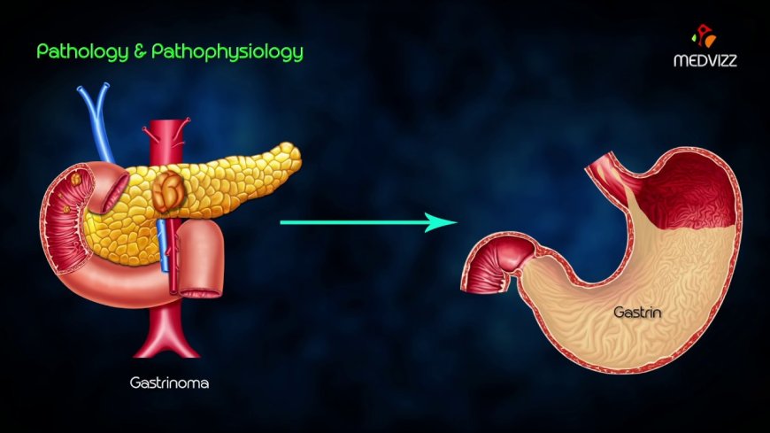 Zollinger-Ellison Syndrome