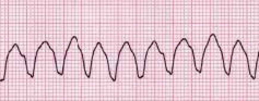 Ventricular tachycardia (VT)