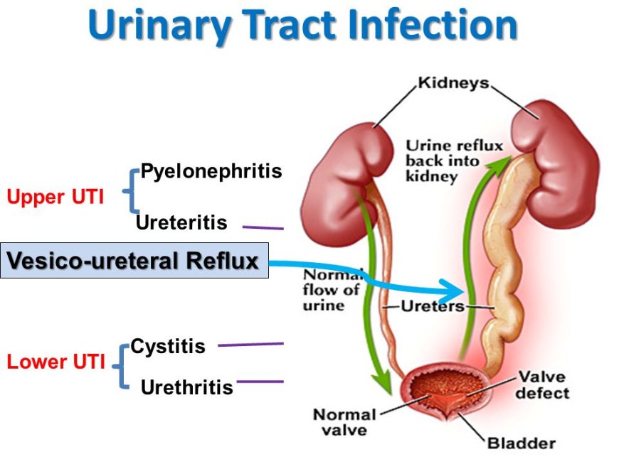 Urinary Tract Infections