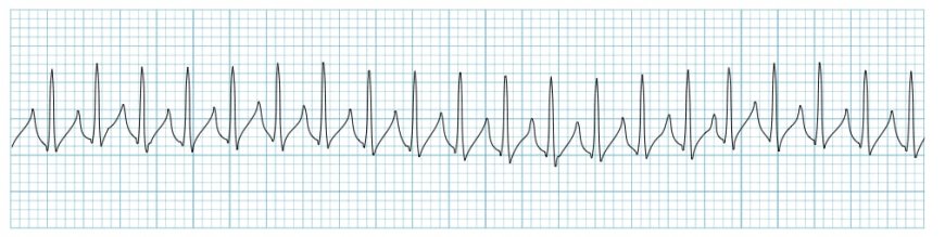 Tachycardia, Supraventricular