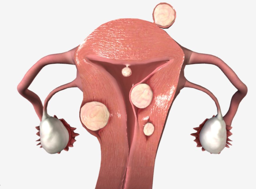 Uterine Bleeding