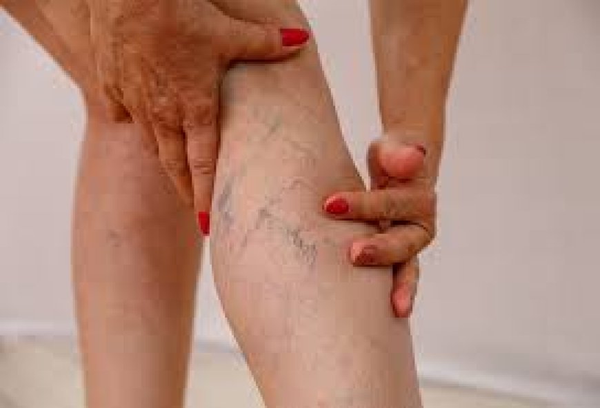 Varicose veins