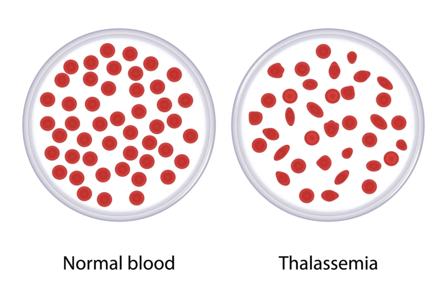 Thalessamia