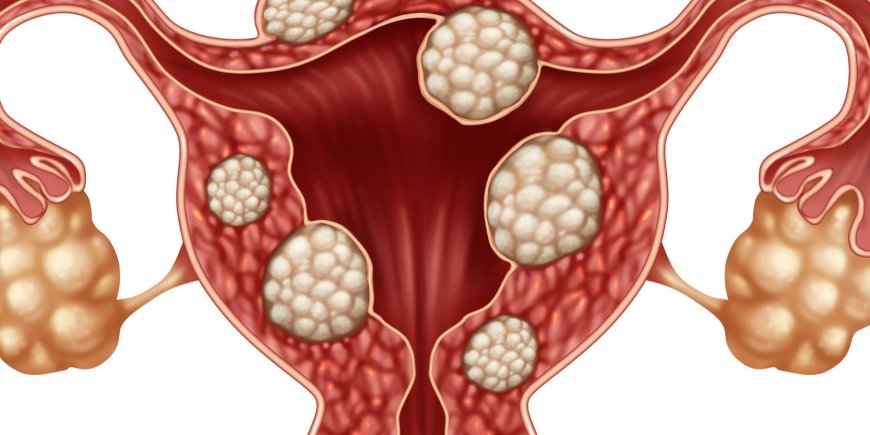 Uterine Fibroids