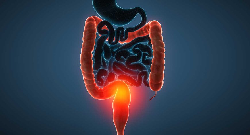 Ulcerative Colitis